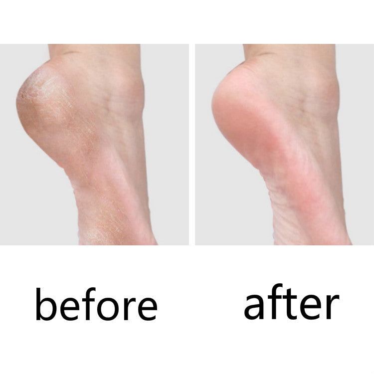 Coltello da pedicure da 10 pezzi per calli della pelle morta