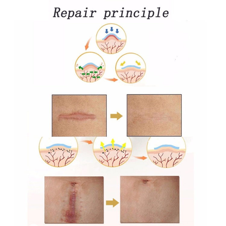Il cerotto per terapia con cicatrici in gel di silicone organico può essere lavato e riutilizzato