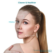 Xpreen Maschera viso per il trattamento dell'acne con terapia della luce blu e rossa