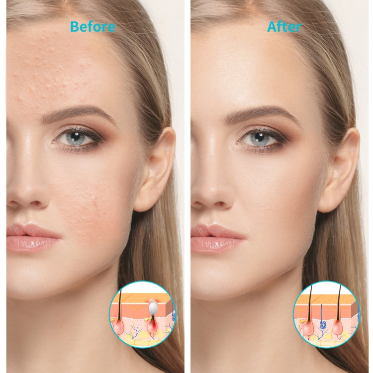 Dispositivo trattamento acne con luce blu e rossa ricaricabile
