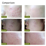 Penna laser K-SKIN KD-7910 per terapia acne e rughe