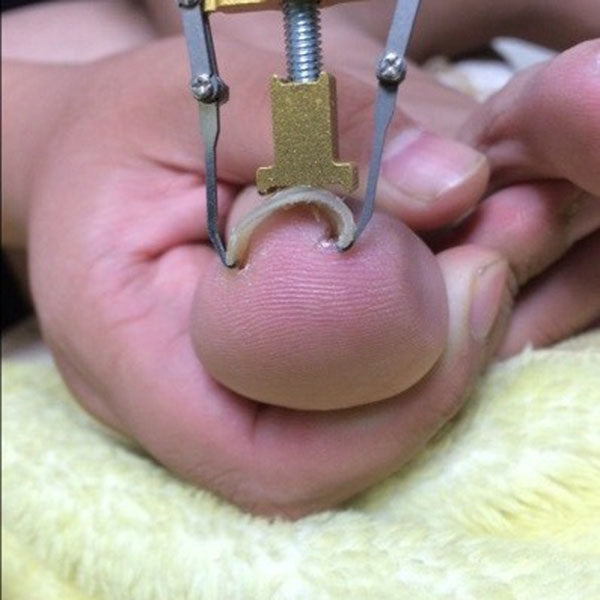 Unghie incarnite Pedicure Piede Strumenti per la cura delle unghie Correttore borsite per dita dei piedi