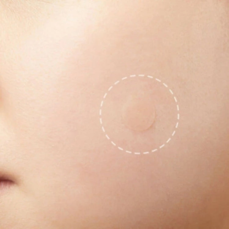 Set 3 strumenti per acne con cerotti per cicatrici