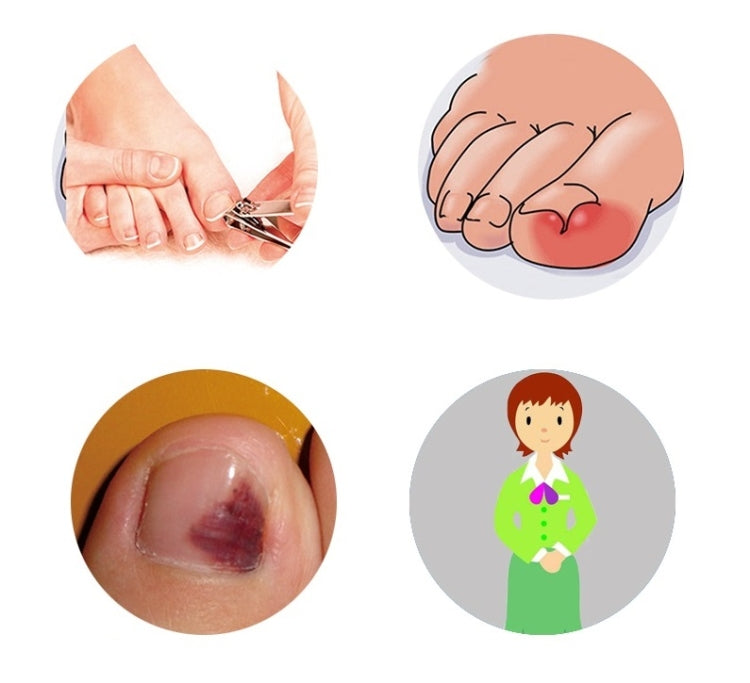 Ortesi per unghie dei piedi 12 in 1 con unghie incarnite
