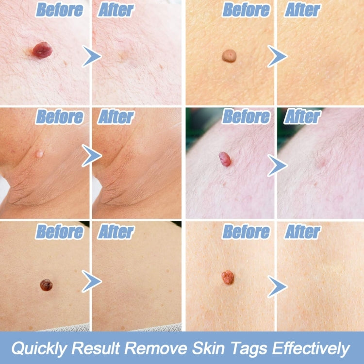 Strumento di rimozione dell'etichetta della pelle per etichette della pelle da 2 mm a 4 mm, Skin Tag Removal Tool, With  Acne Patch