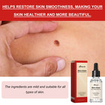 EELHOE 30 ml/bottiglia anti talpa e verruca liquido per rimuovere macchie scure essenza per la pelle